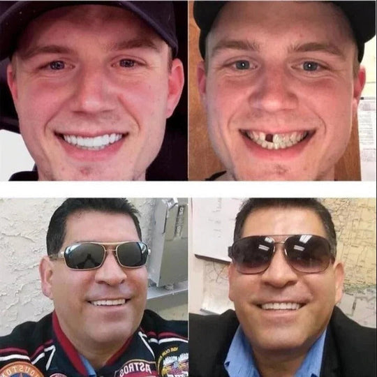 Cosmetic Veneers with Adjustable Fit and Complete Set