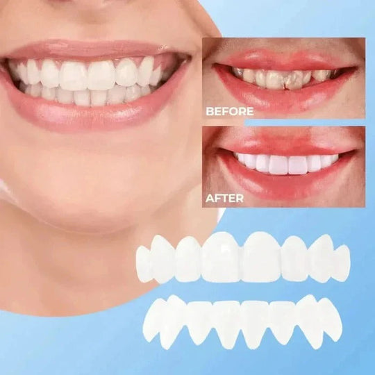 Cosmetic Veneers with Clip-On Design and Temporary Covers