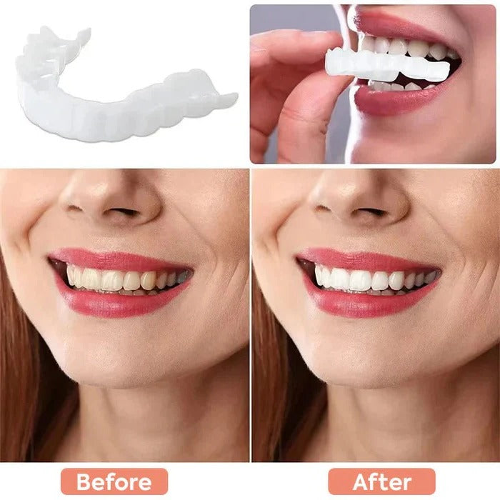 Cosmetic Veneers with Clip-On Design and Temporary Covers