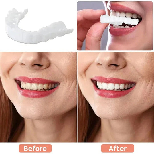 Cosmetic Veneers with Clip-On Design and Temporary Covers
